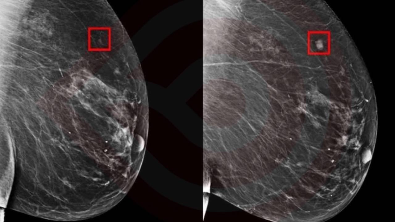 ‘Inteligencia Artificial Revela Potencial para Detectar Cáncer de Mama Años Antes con Modelo Innovador’